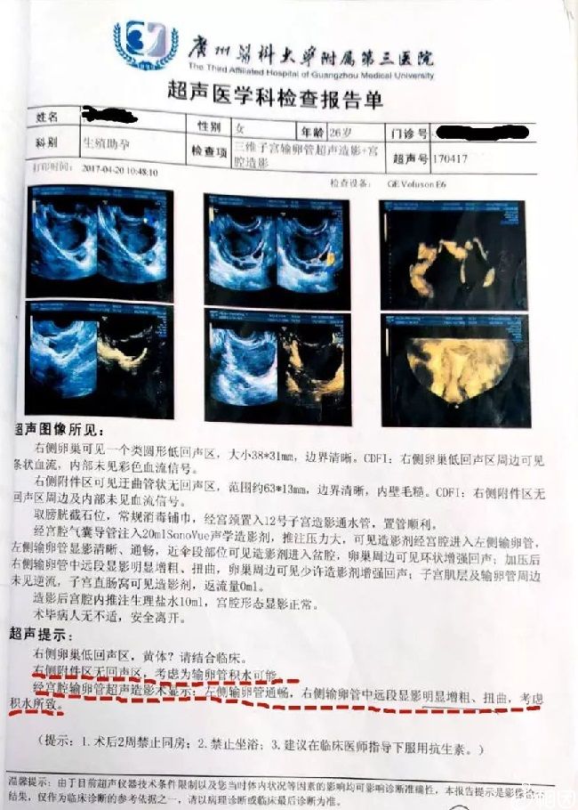 卵巢超声检查 卵巢超声检查