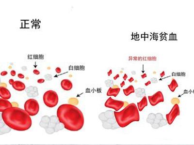 地中海贫血