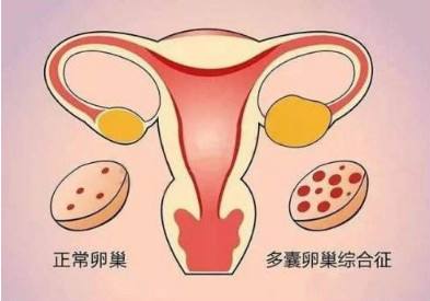 多囊卵巢综合征