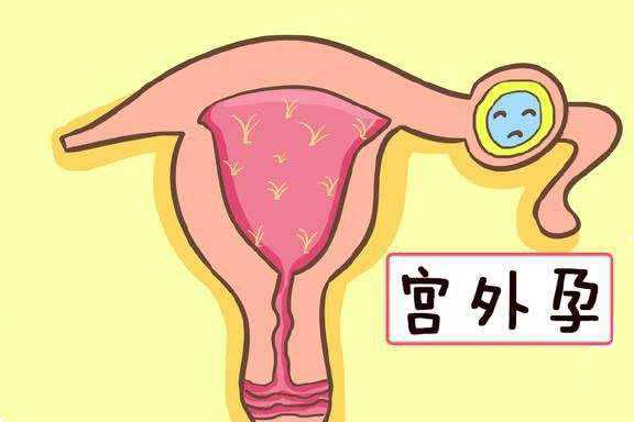 宫外孕