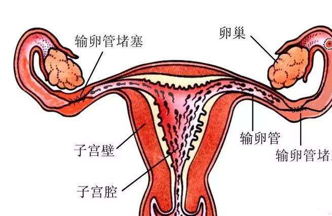 输卵管堵塞